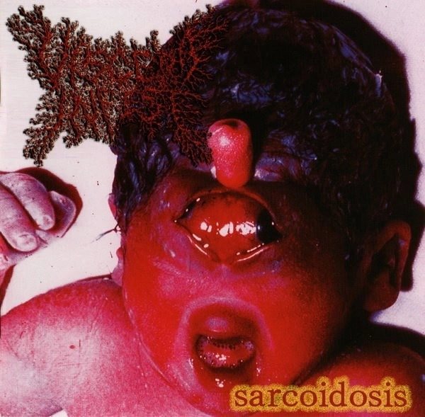 VISCERA INFEST / ヴィセラ・インフェスト / サルコイドーシス / SARCOIDOSIS