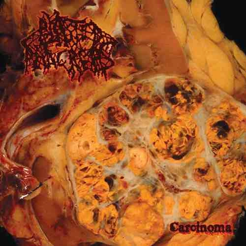 BLASTED PANCREAS / CARCINOMA